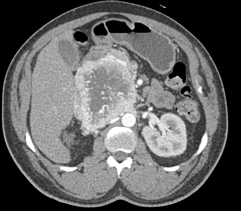 CTisus 澳洲幸运5开奖官网开奖 Scanning | Pancreatic Neuroendocrine Tumor