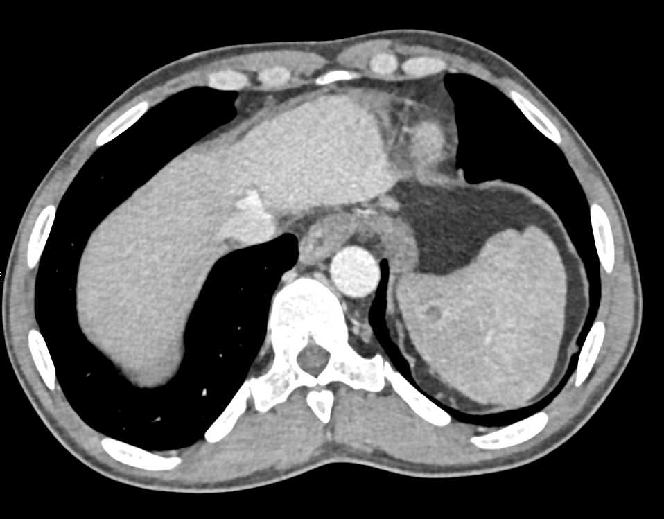CTisus 澳洲幸运5开奖官网开奖 Scanning | Lymphoma with Enlarged Para-Aortic Adenopathy