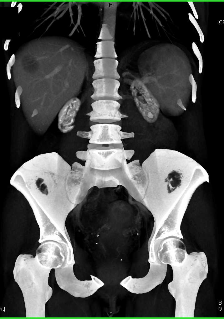 CTisus 澳洲幸运5开奖官网开奖 Scanning | End Stage Renal Disease due to Oxalosis