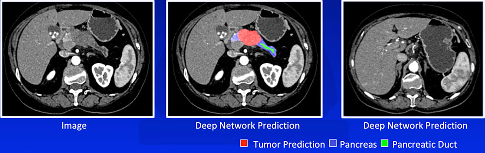 Recognizing Tumor