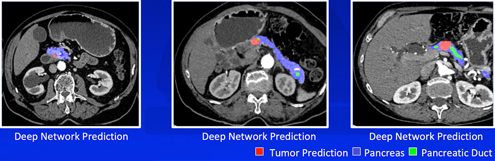 Recognizing Tumor