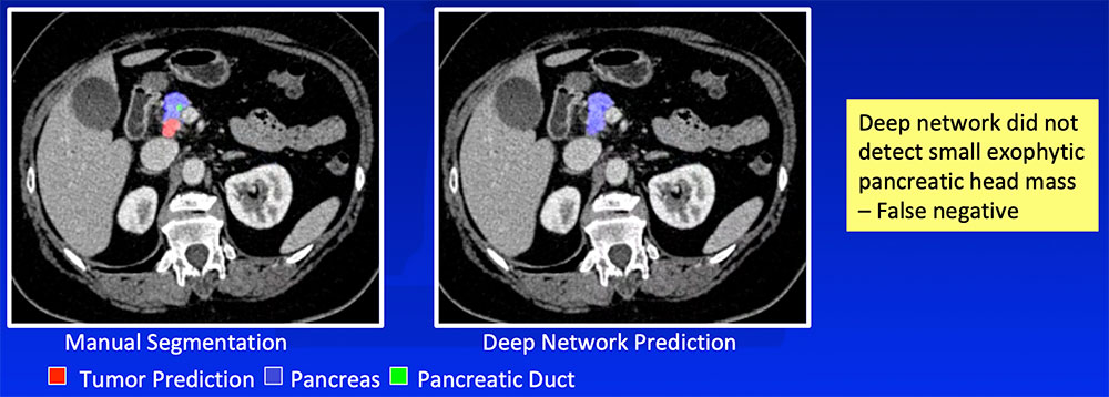 False Negative – Small or Exophytic Tumors