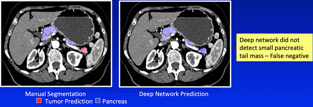 False Negative – Small or Exophytic Tumors