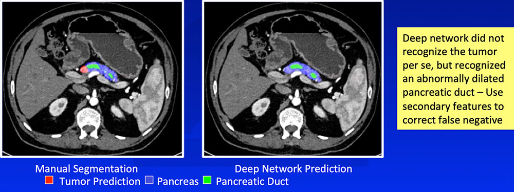 False Negative – Isoattenuating Tumors