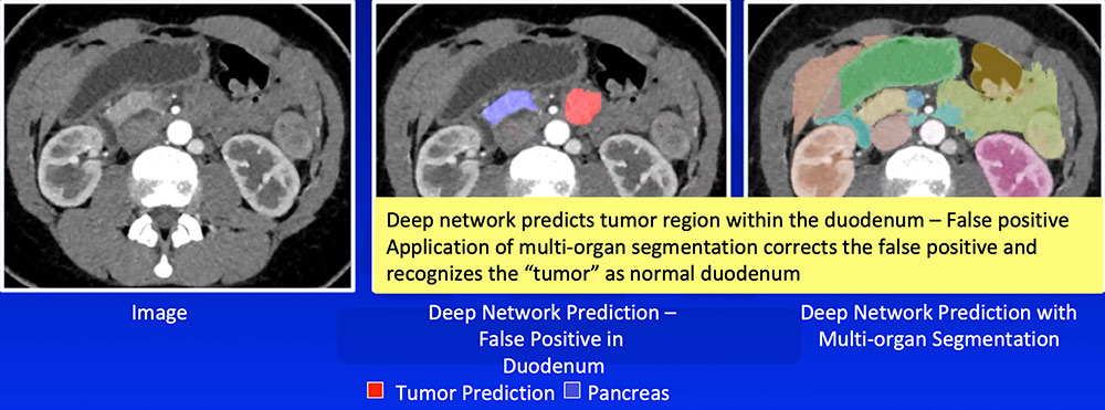 False Positive – Prediction of Tumor Outside Pancreas