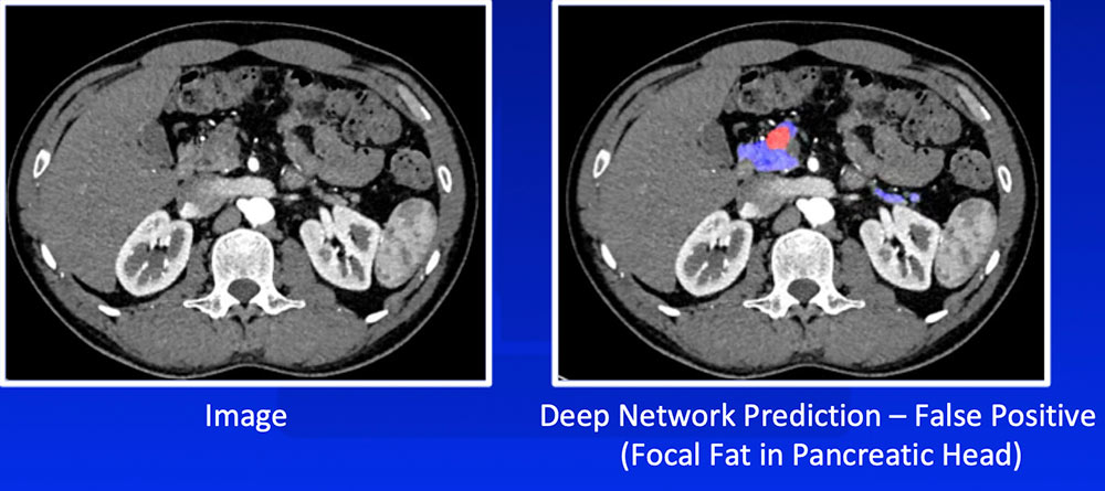 False Positive – Focal Fat