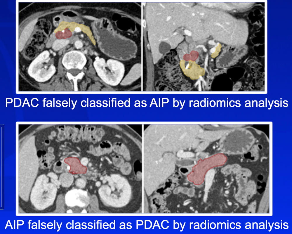 Differentiation of Autoimmune Pancreatitis from PDAC