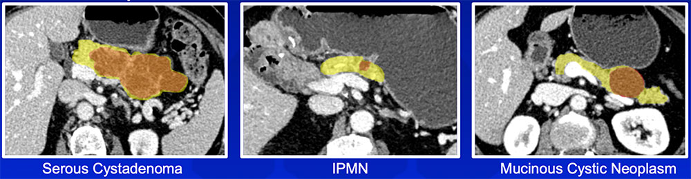 Classification of Pancreatic Cysts