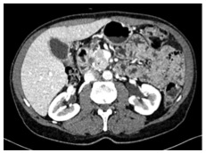 Detection of PDAC