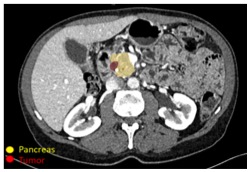 Detection of PDAC