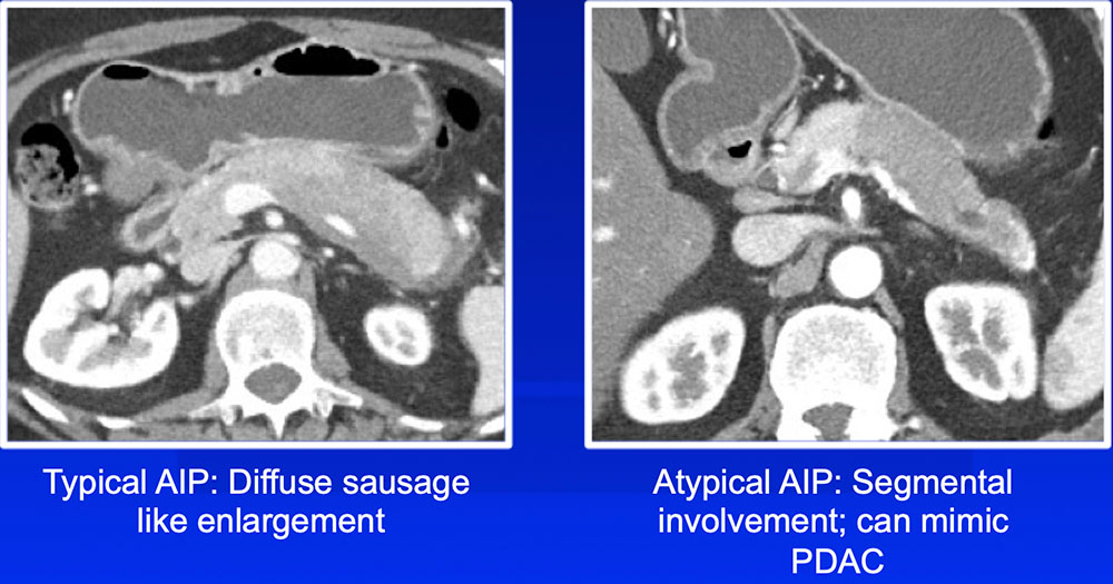Differentiation of Autoimmune Pancreatitis from PDAC