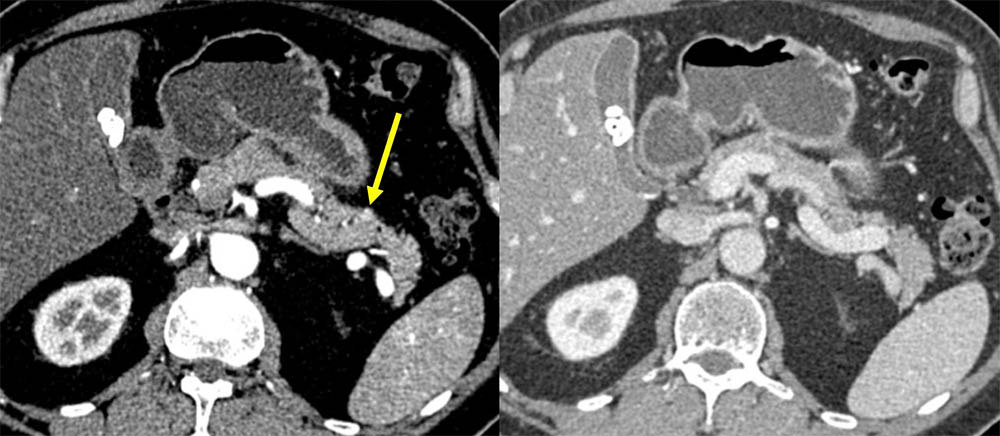 Example of challenging PNET case for segmentation