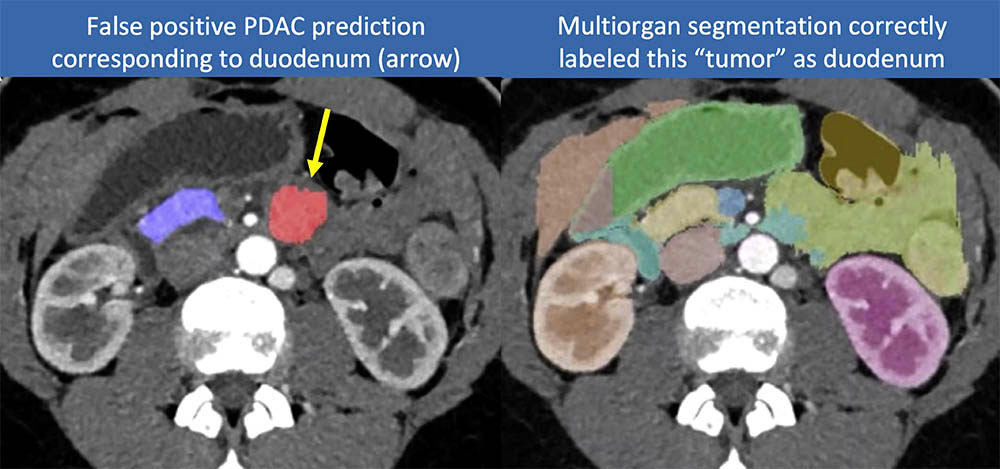 Example of advantage to segment other abdominal organs
