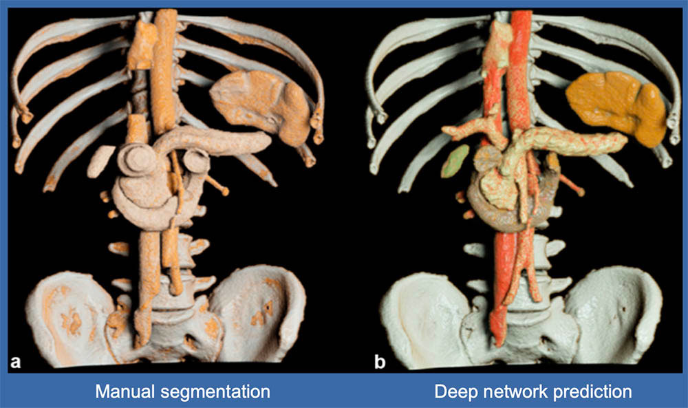 Deep network prediction of normal pancreas