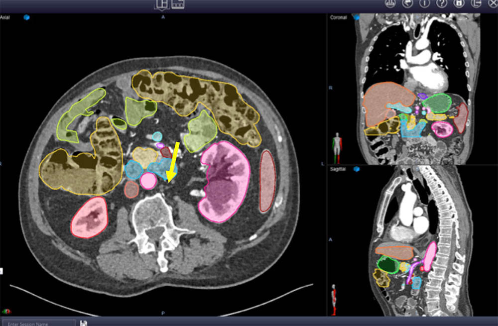Deep network prediction of pancreatic cancer