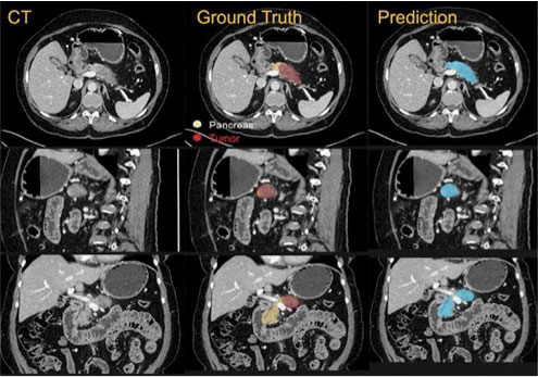 Deep network prediction of pancreatic cancer