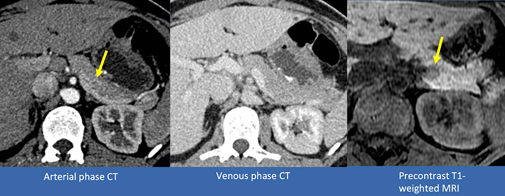 Example of FALSE NEGATIVE case of deep network prediction of pancreatic cancer (PNET)