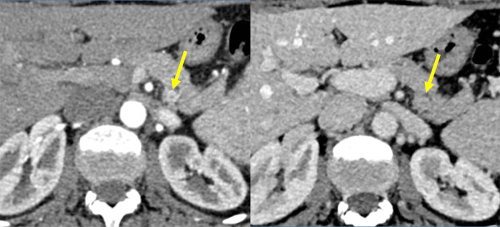 Example of FALSE NEGATIVE case of deep network prediction of pancreatic cancer (PNET)