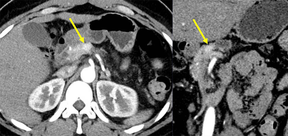 Example of FALSE NEGATIVE case of deep network prediction of pancreatic cancer (PNET)