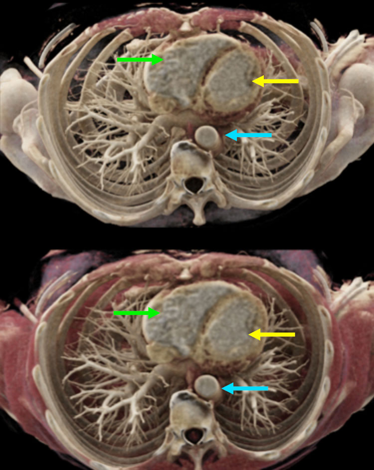 Cardiac