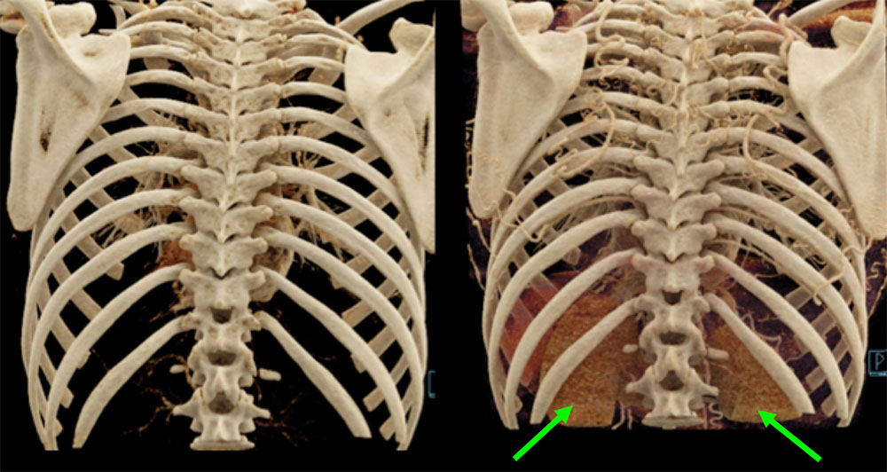 Bones