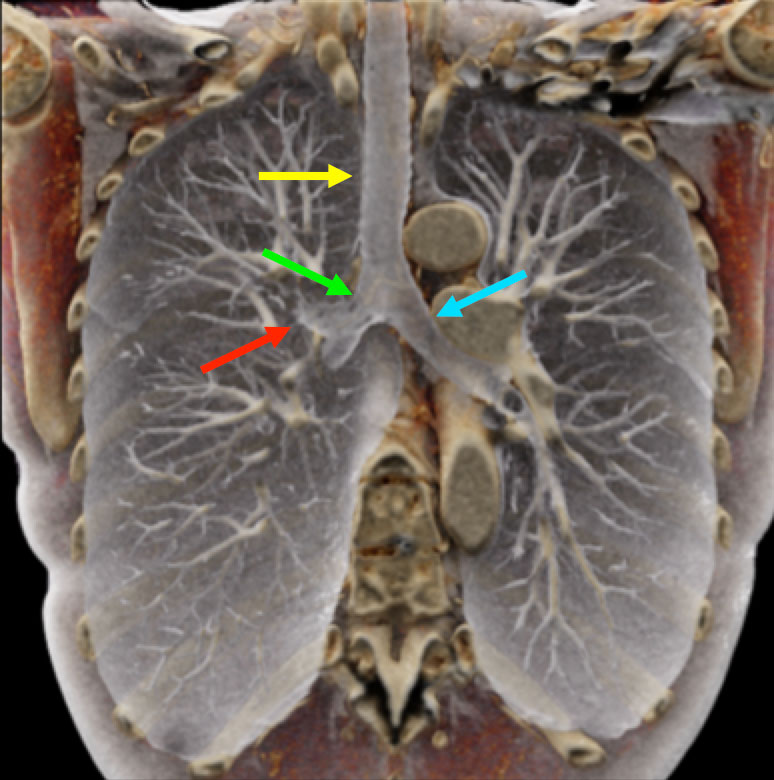 Lungs and Airways