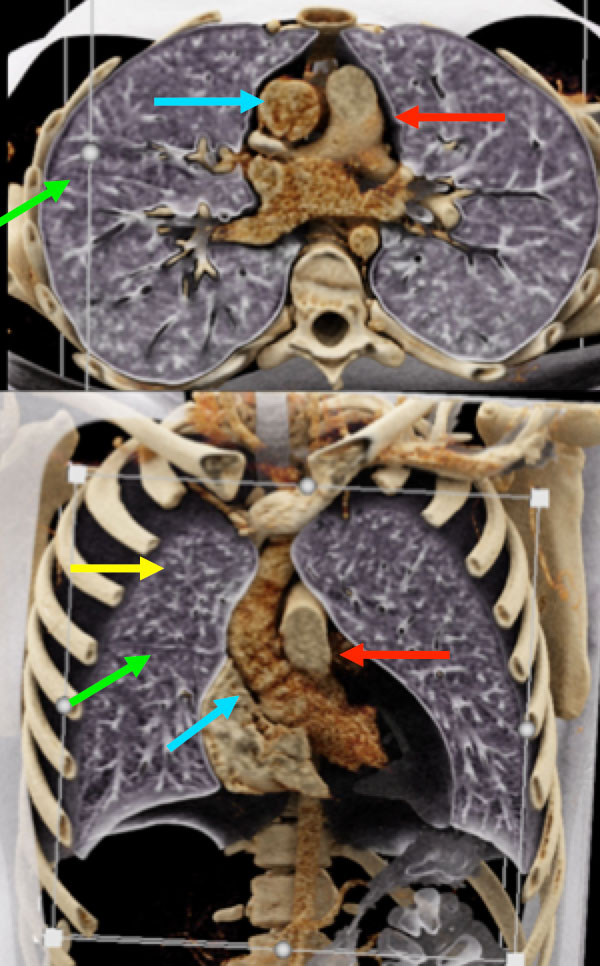 Lungs and Airways
