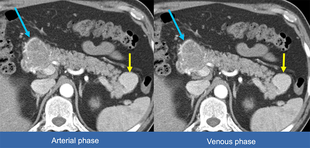 Deep Network Prediction for Detection of PNET Found Multiple Tumors: Need Confirmation of Multi-tumor Cases vs. Annotation/Segmentation Error