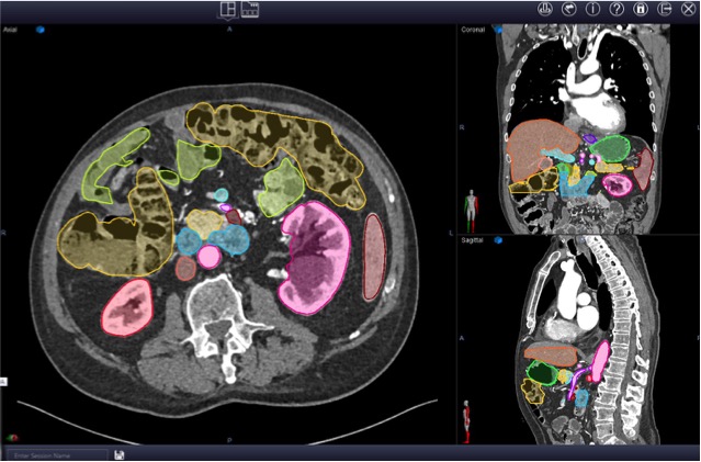 Image Segmentation (Pancreatic Cancer)