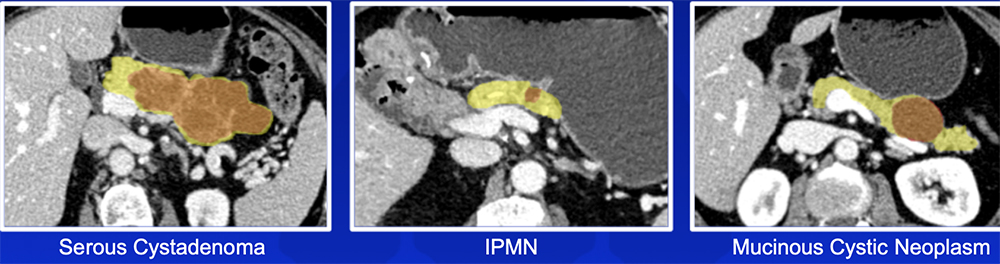 Pancreatic Cyst Risk Stratification - Our Experience