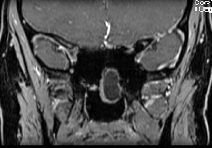 Meningoencephalocele - CTisus CT Scan