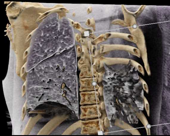 LUL Surgery with virtual Bronchoscopy - CTisus CT Scan