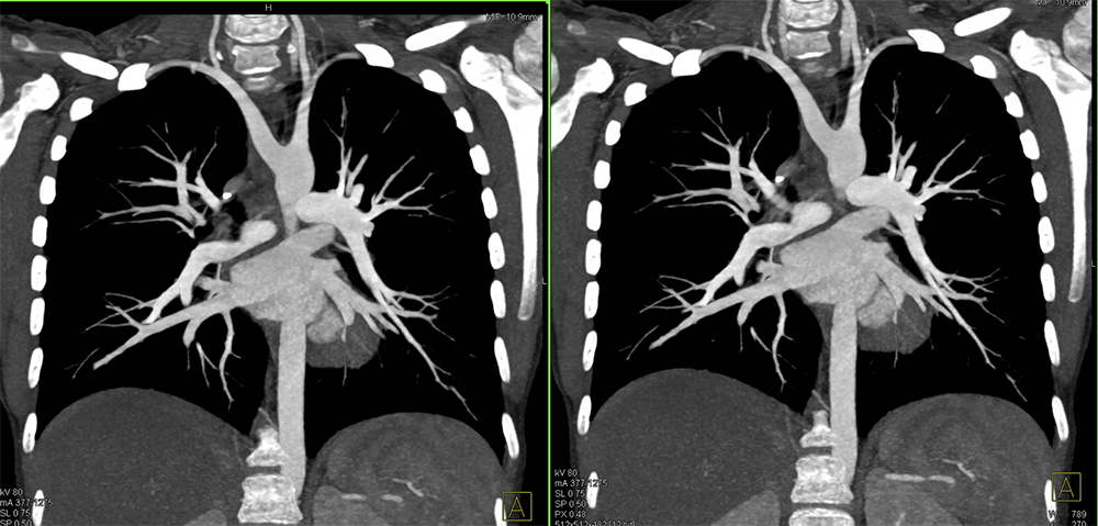 Abberrant Right Subclavian Artery