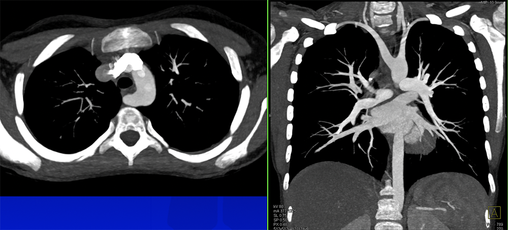 Abberrant Right Subclavian Artery