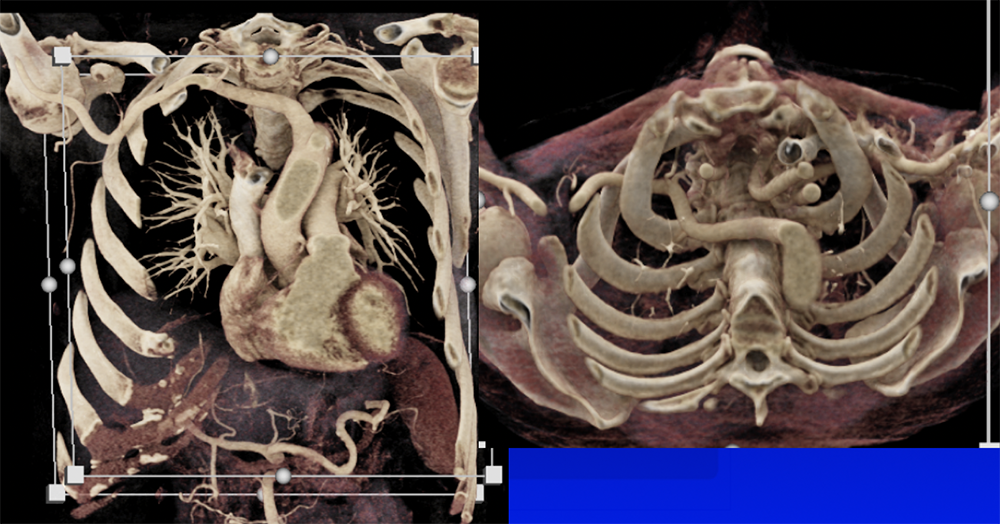 Abberrant Right Subclavian Artery
