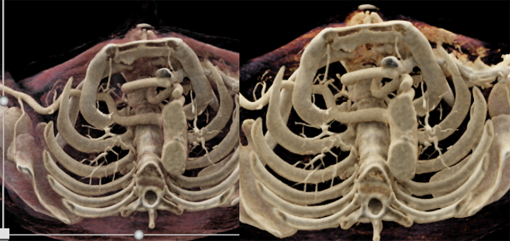 Abberrant Right Subclavian Artery