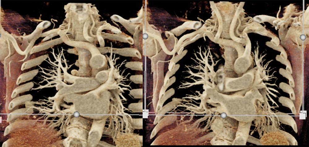 Abberrant Right Subclavian Artery
