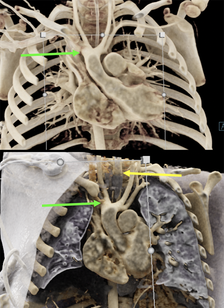 Double Aortic Arch
