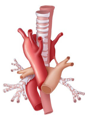 Right AA with aberrant left subclavian artery