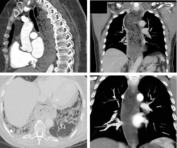 Achalasia