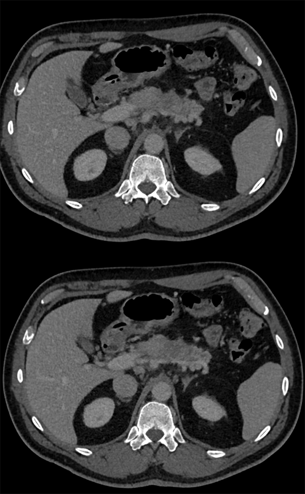 Adenocarcinoma Pancreas