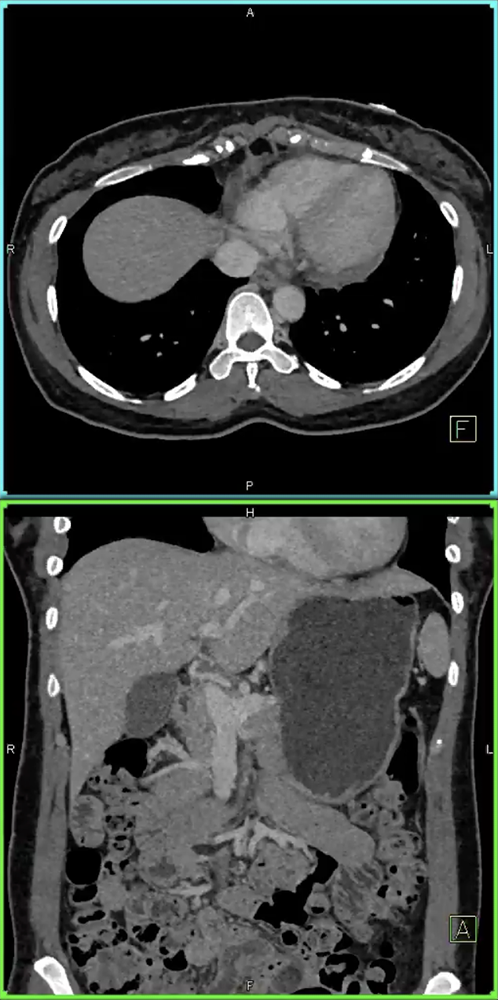 Abdominal Pain for 2 Years
