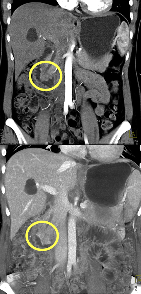 AI in Radiology: Current Status