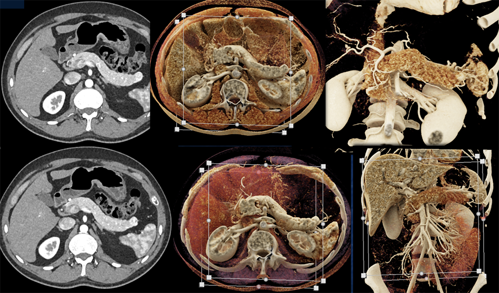 PNET Tail of Pancreas 1cm