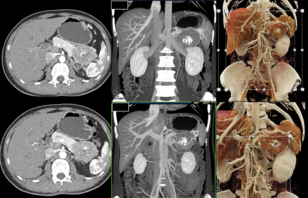 Neuroendocrine Tumor TOP With Calcifications