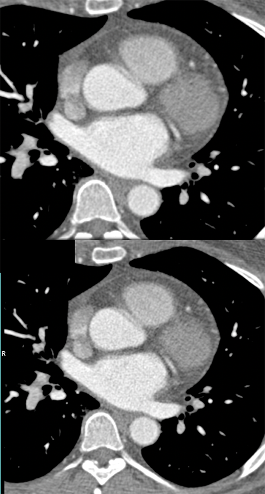 MVA-r/o Dissection