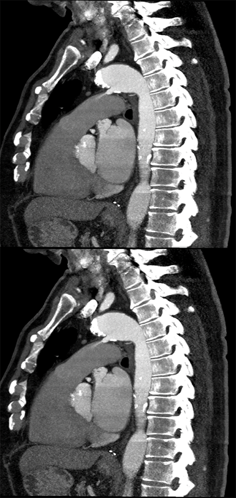 Trauma to the Thoracic Aorta