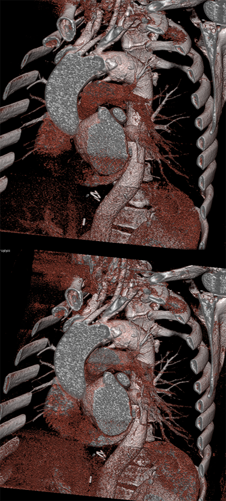 Trauma to the Thoracic Aorta