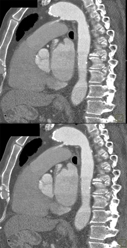 Trauma to the Thoracic Aorta
