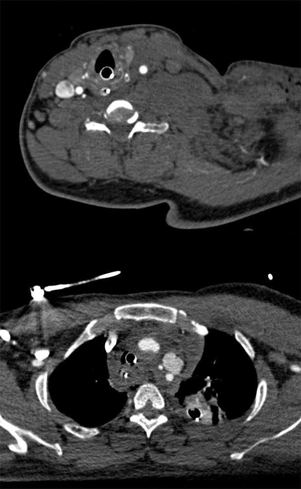 GSW with Bleed from Aorta Near Left Subclavian Artery